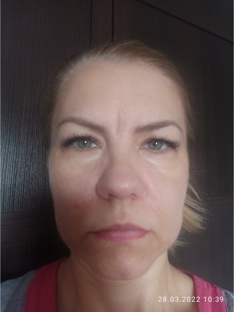 Фото 1. Что можно сделать, чтобы убрать межбровную морщину?