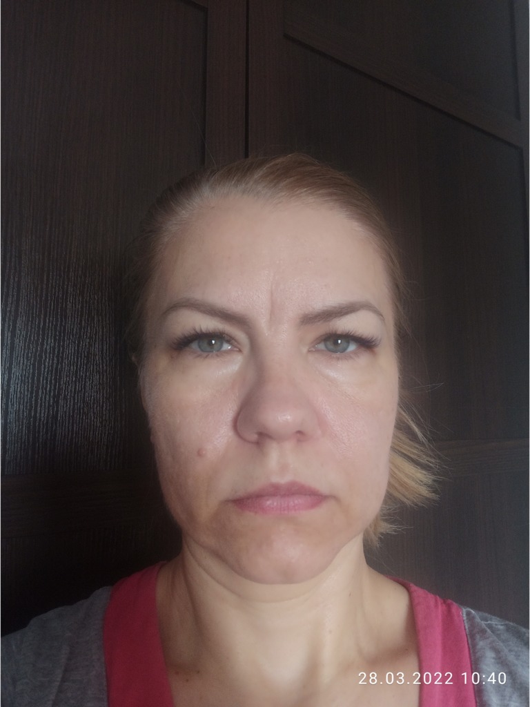 Фото 2. Что можно сделать, чтобы убрать межбровную морщину?