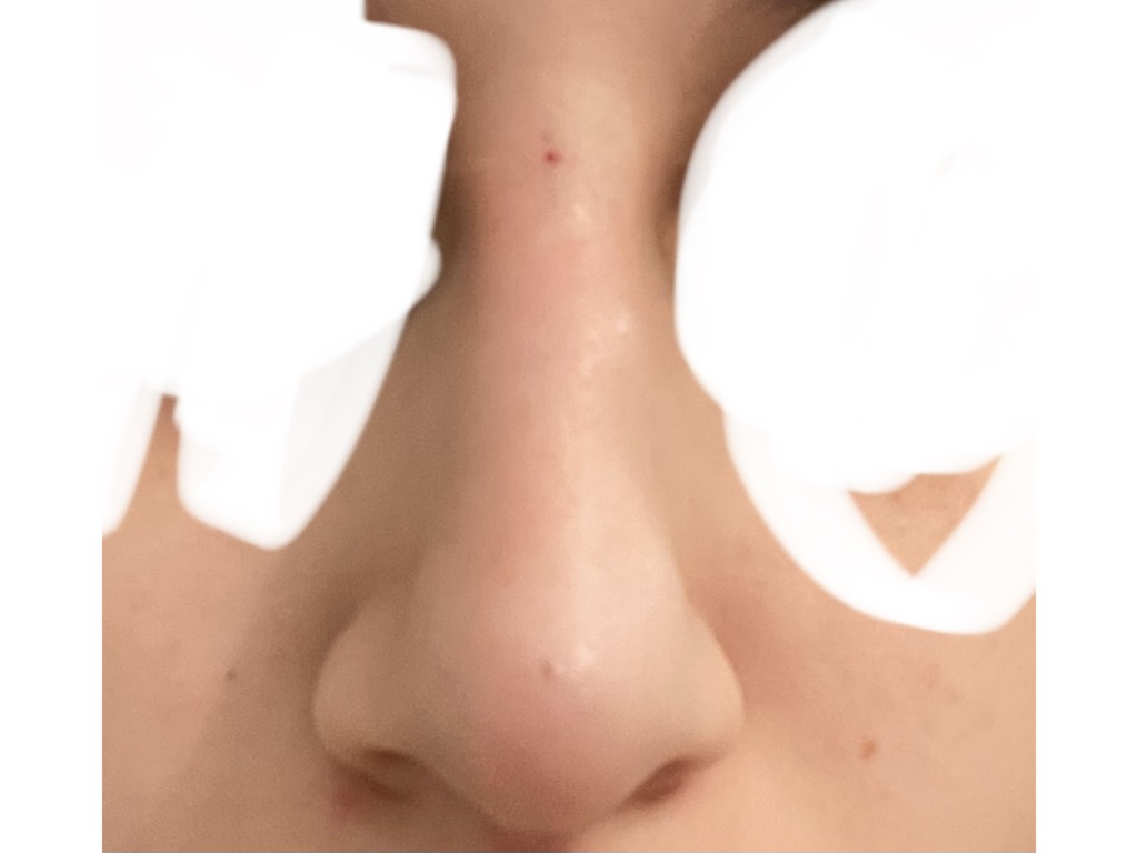 Фото 1. Остались следы после безоперационной ринопластики