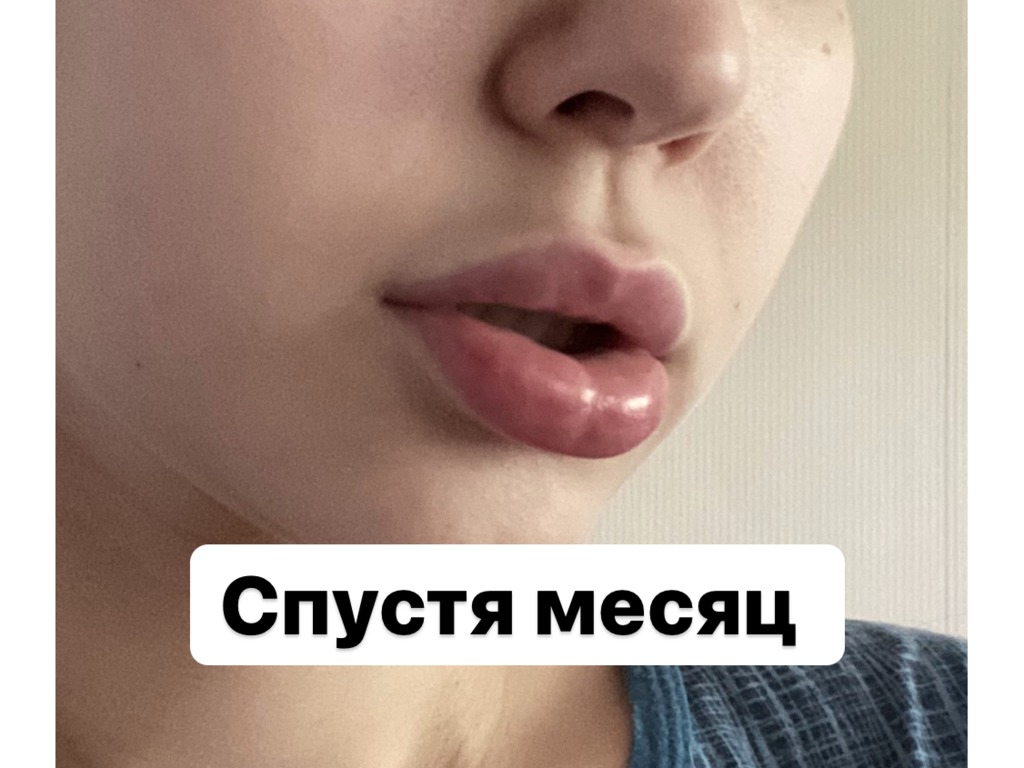 Фото 4. Последствия коррекции губ