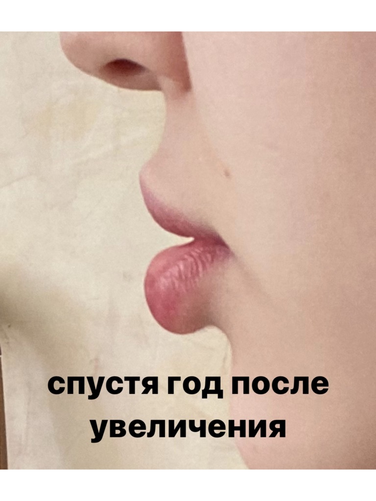 Фото 1. Последствия коррекции губ