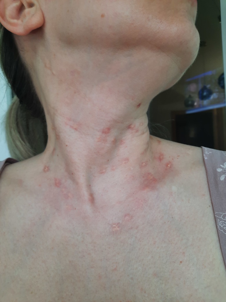 Фото 3. Папулы на шее после введения подкожно радиесса