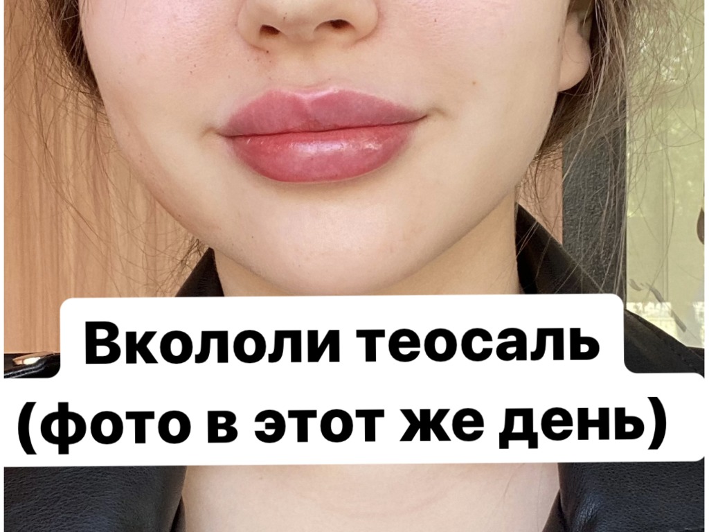 Фото 3. Последствия коррекции губ