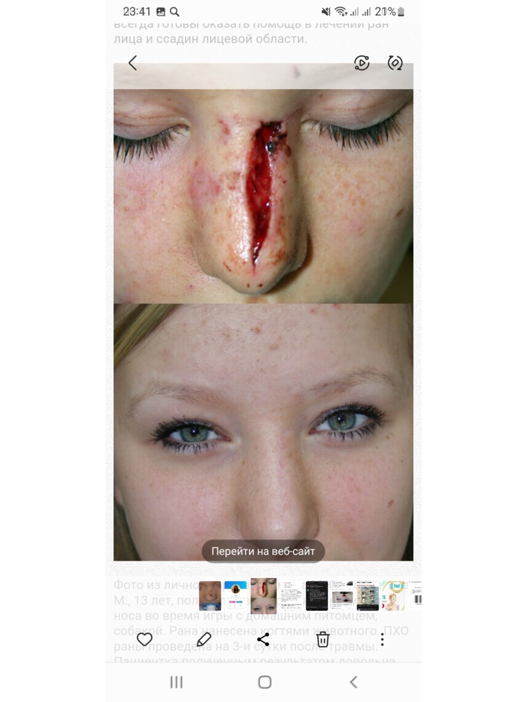 Фото 1. Рваная рана спинки носа