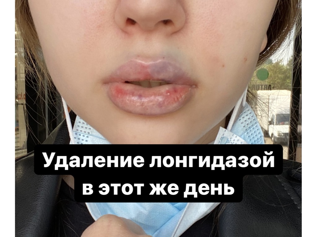 Фото 2. Последствия коррекции губ