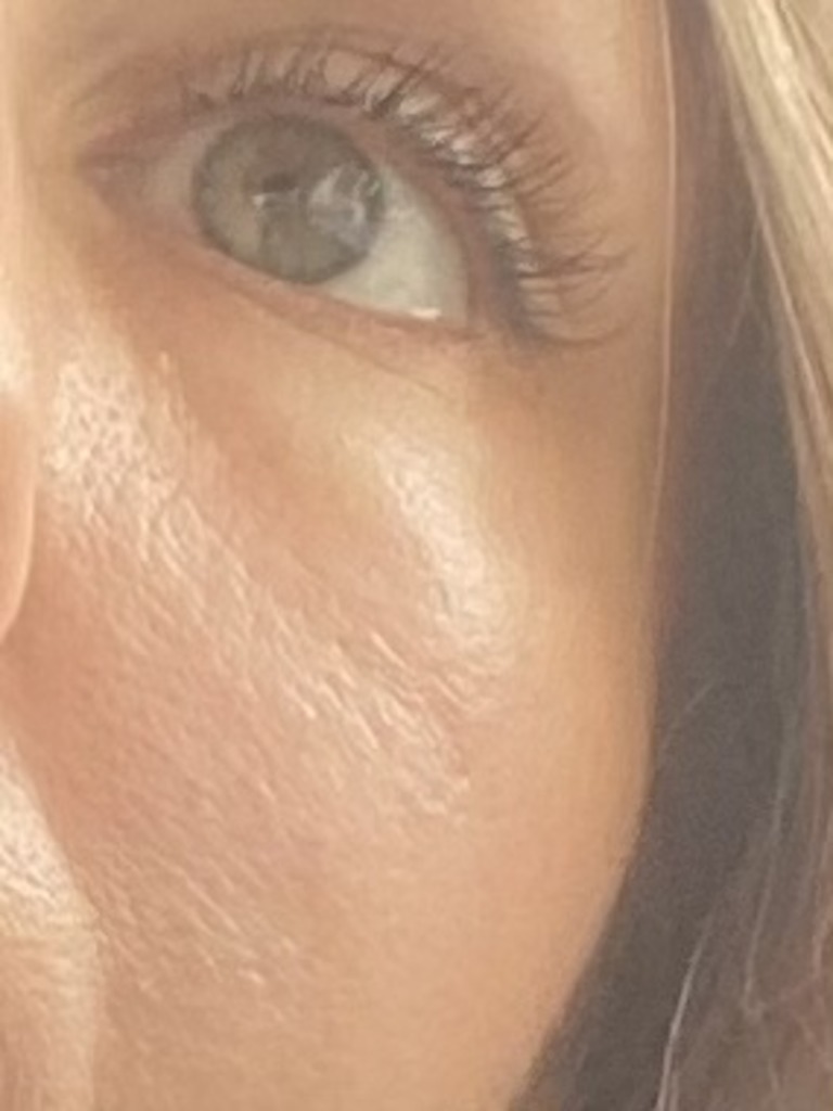 Фото 1. Отеки после коррекции релатоксом