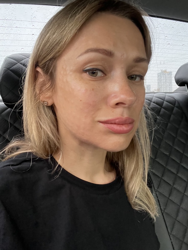 Фото 1. Папулы после мезотерапии