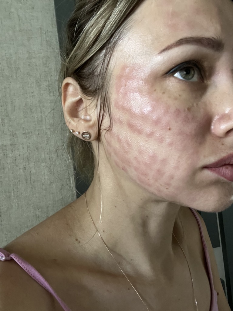 Фото 2. Папулы после мезотерапии