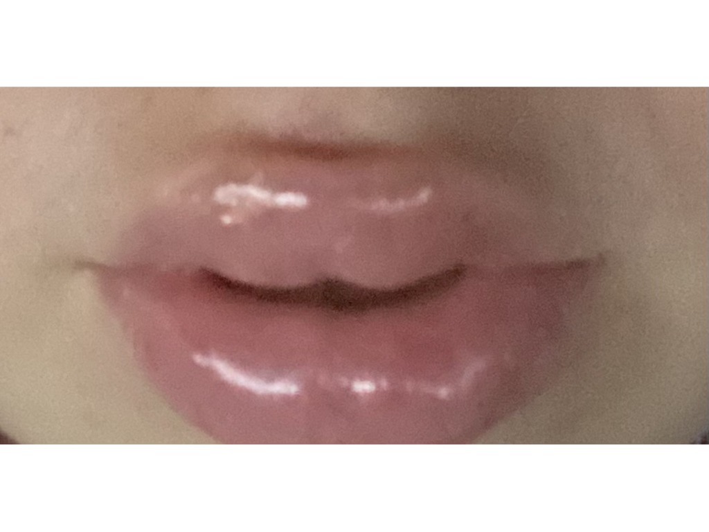 Фото 1. Ямка на верхней губе