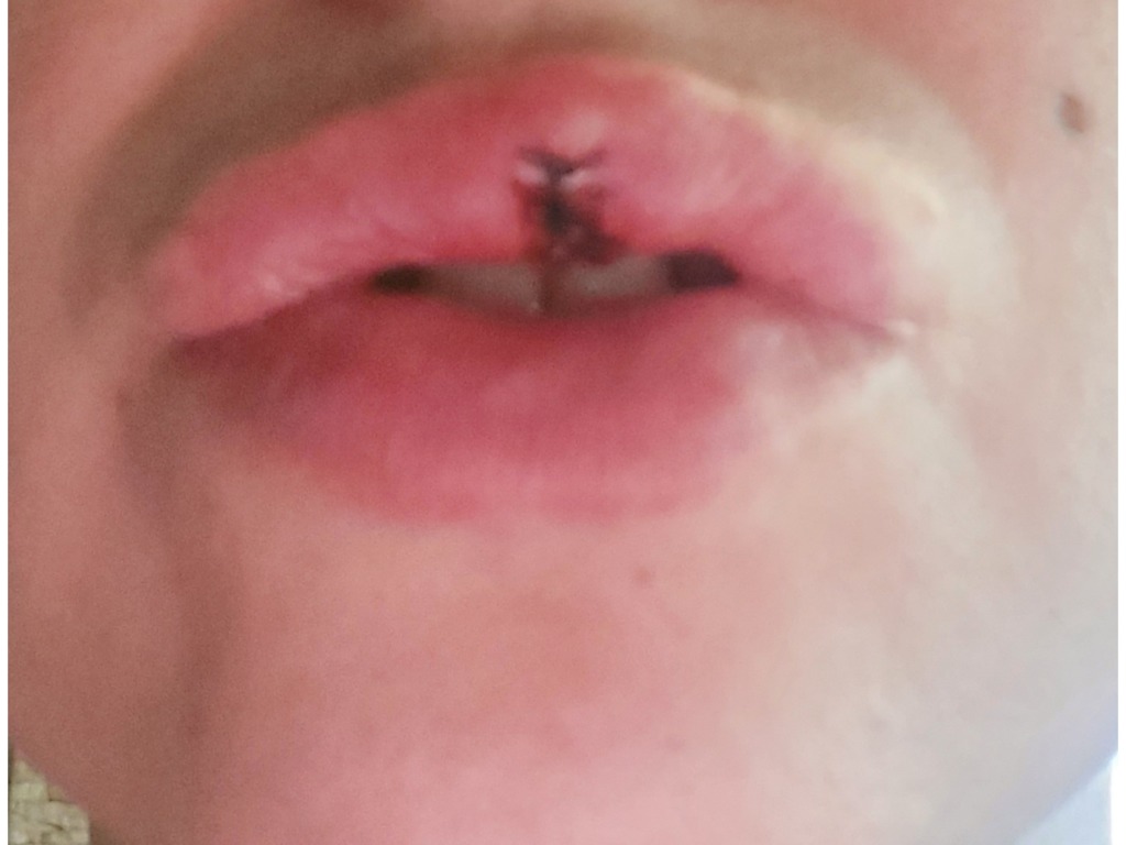 Фото 2. Складка на губе