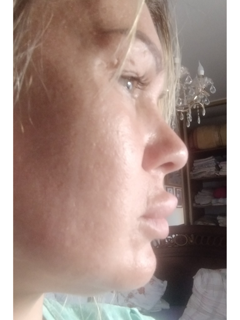 Фото 2. Остаточный эффект после коррекции губ