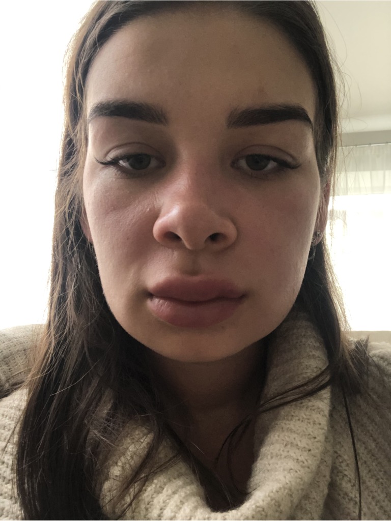 Фото 1. Отек после лонгидазы