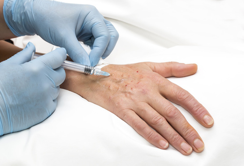 папулы после биоревитализации на руке