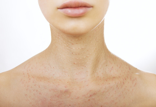 папулы после биоревитализации на груди