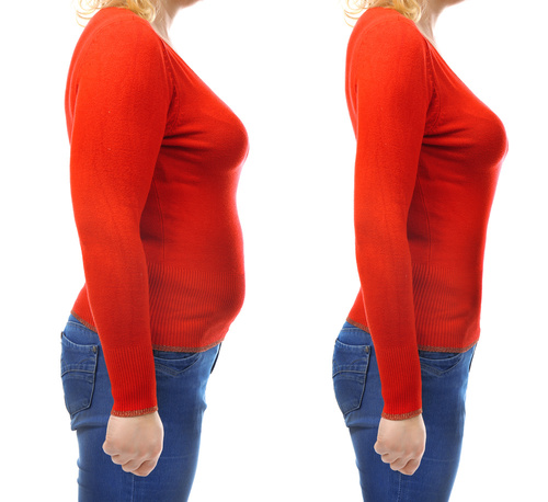 до/после пластики живота