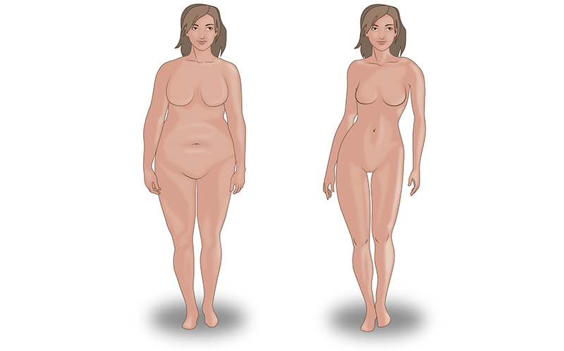 Бодилифтинг