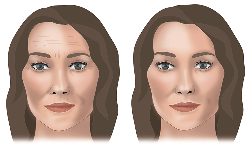 Инъекции ботокса