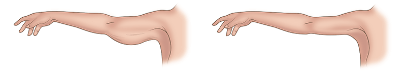 Брахиопластика