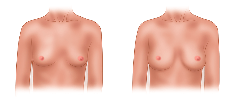 Увеличение груди