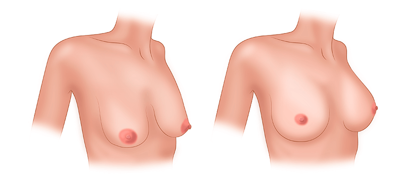 Подтяжка груди