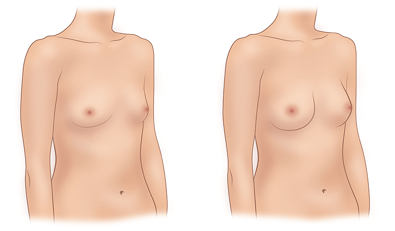 Липофилинг груди