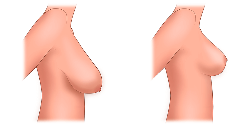 Уменьшение груди