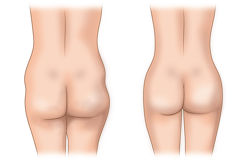 Липофилинг ягодиц
