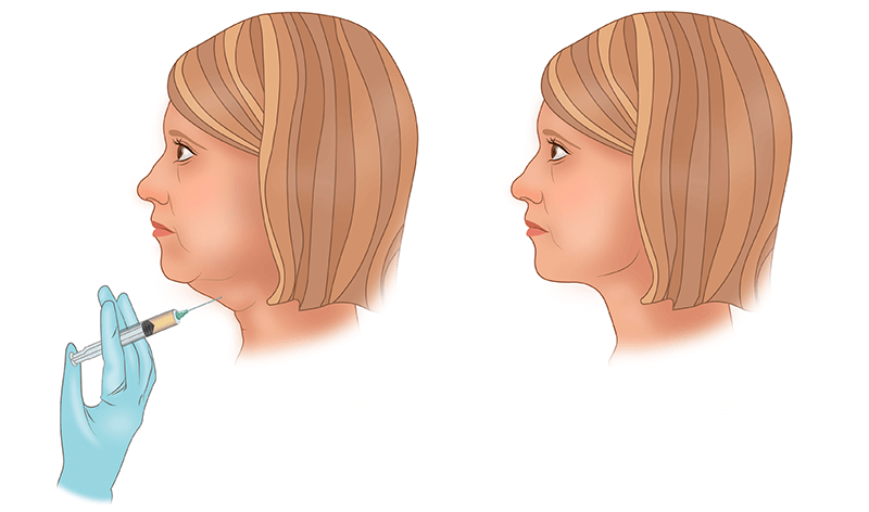 Химическая липосакция
