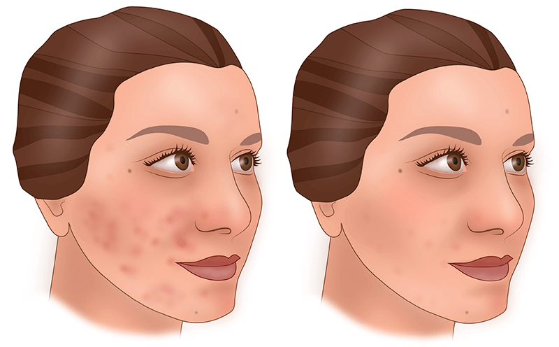 Химический пилинг