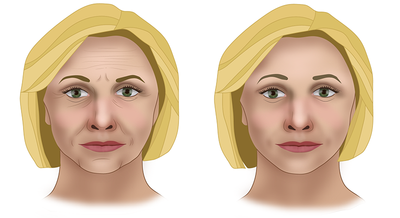Эндоскопическая подтяжка лица