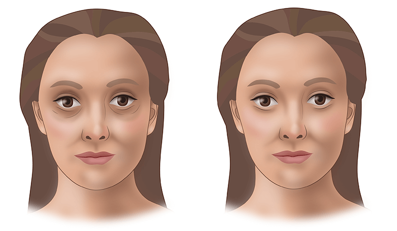 Липофилинг век