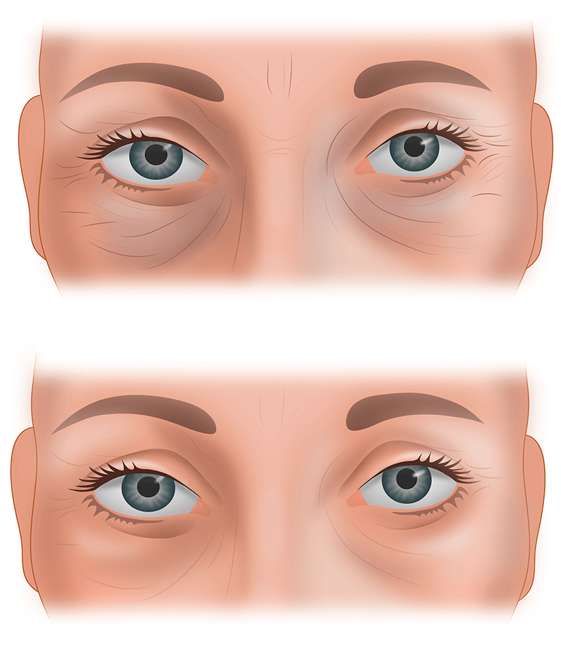 Мезотерапия вокруг глаз