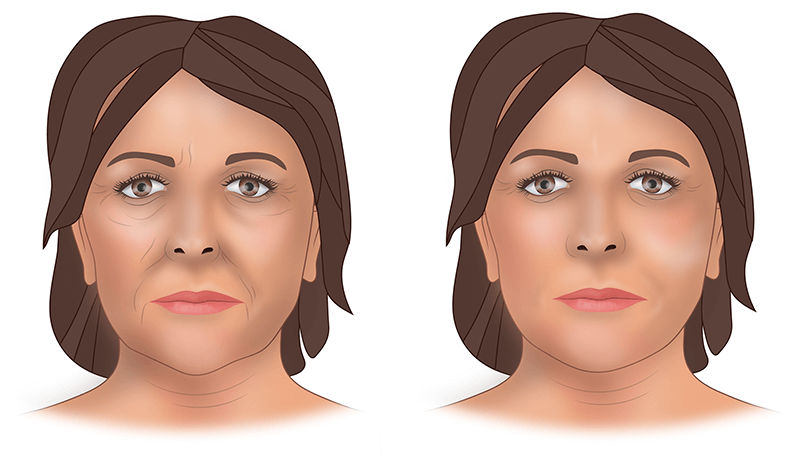 Липофилинг лица