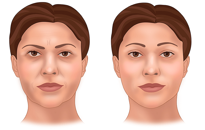 Подтяжка лица