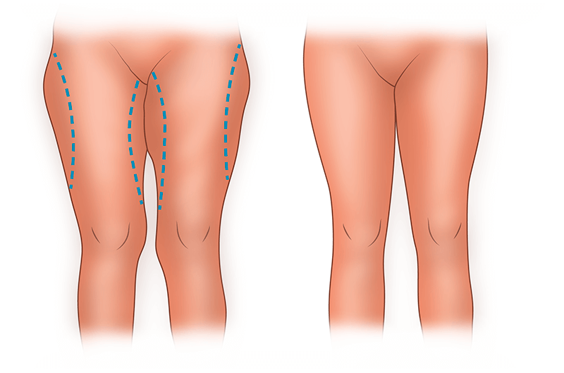 Феморопластика