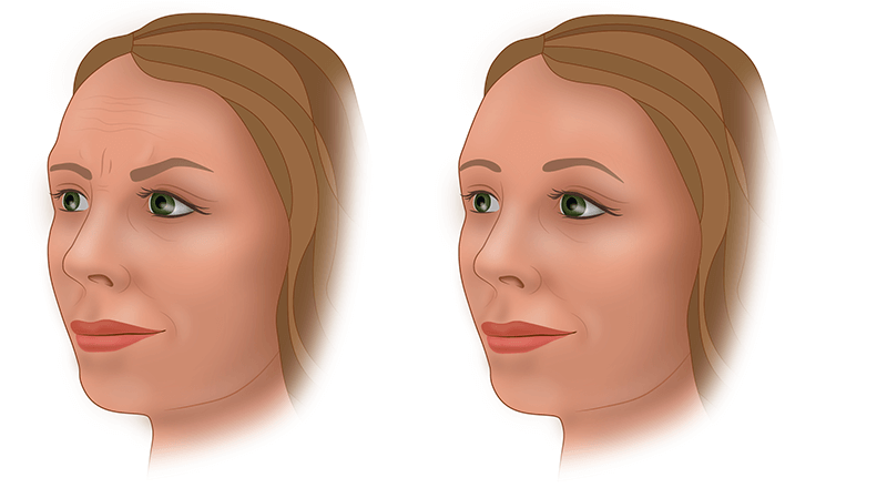 Подтяжка лба