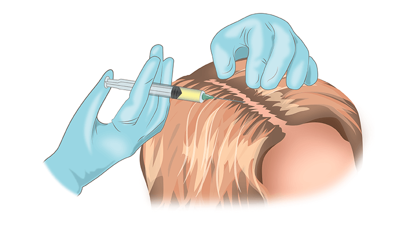 Мезотерапия для волос