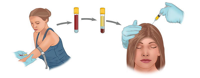 Плазмолифтинг для волос
