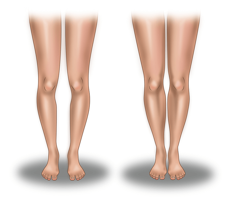 Круропластика