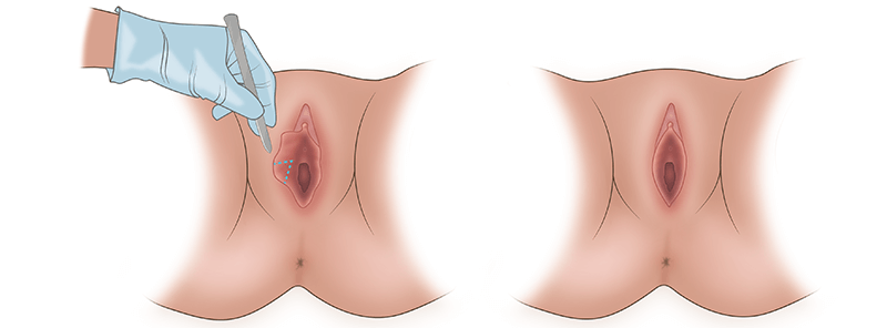 Лабиопластика