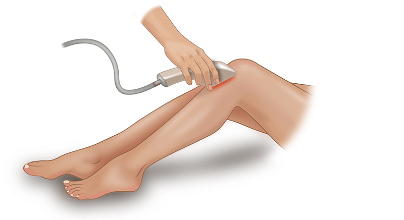 Лазерная эпиляция