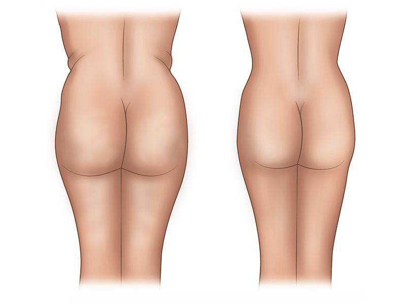 Лазерная липосакция