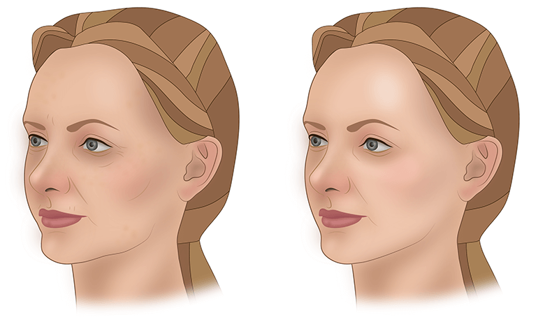 Лазерный пилинг