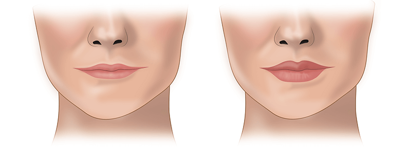 Контурная пластика губ