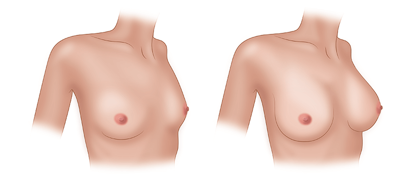 Маммопластика