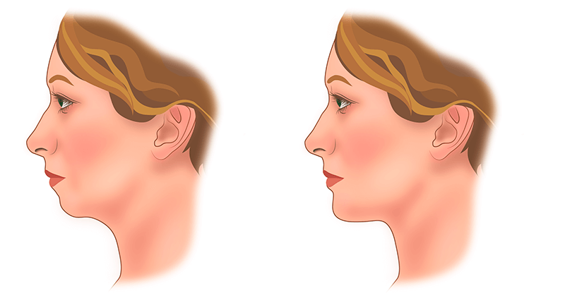 Ментопластика