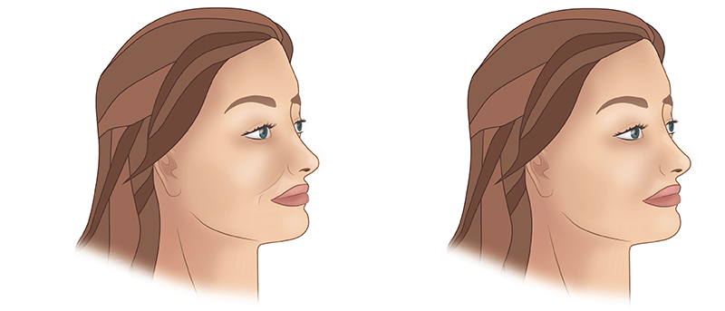 Контурная пластика носогубных складок