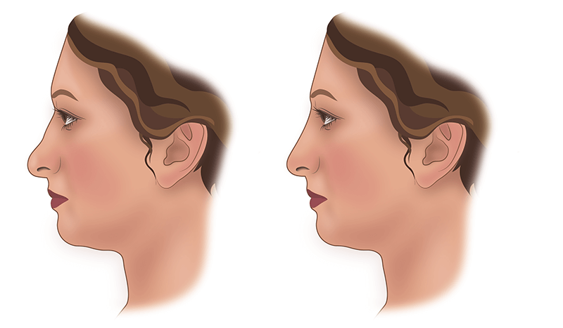 Контурная пластика носа