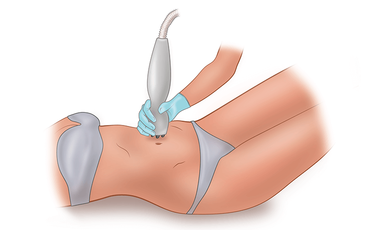 Радиочастотная липосакция