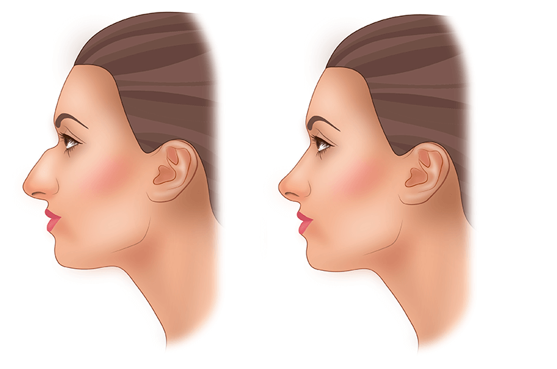 Ринопластика (пластика носа)